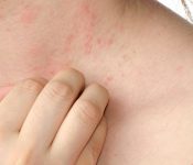 Top 7 những trái cây nên ăn khi bị mụn