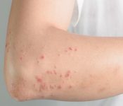 Top 7 những trái cây nên ăn khi bị mụn