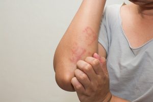 cách chữa trị eczema