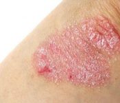 Top 7 những trái cây nên ăn khi bị mụn