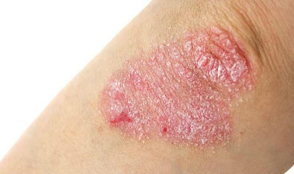 cách chữa trị eczema