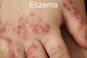 cách chữa trị eczema