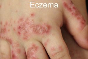 cách chữa trị eczema