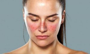 Nguyên nhân gây dị ứng thời tiết ở mặt