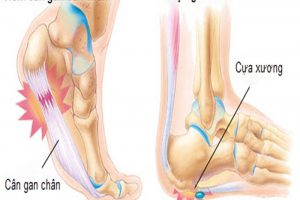 Viêm gân gót chân là bệnh gì? Cách điều trị như thế nào?