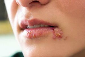 Bệnh lở miệng (giộp môi) là bệnh gì? Cách chữa bệnh giộp môi tại nhà
