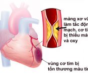 Những triệu chứng của bệnh thiếu máu cơ tim