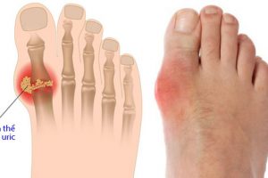 Góc giải đáp: Bệnh Gout là gì? Nguyên nhân và dấu hiệu nhận biết ra sau