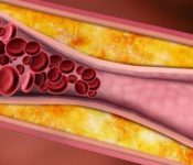 5 Bài thuốc nam chữa bệnh mỡ máu cao bạn không nên bỏ qua
