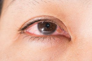 Các bệnh về mắt thường gặp nhất là mắt bị dị ứng