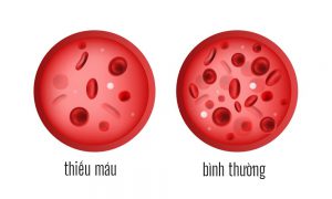 Người thiếu máu thường có lượng hồng cầu và nồng độ Hemoglobin bên trong hồng cầu thấp.