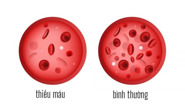 Người thiếu máu thường có lượng hồng cầu và nồng độ Hemoglobin bên trong hồng cầu thấp.