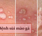 Bệnh có những nốt sần sùi màu hồng nhạt xuất hiện ở nhiều vị trí trên cơ thể.